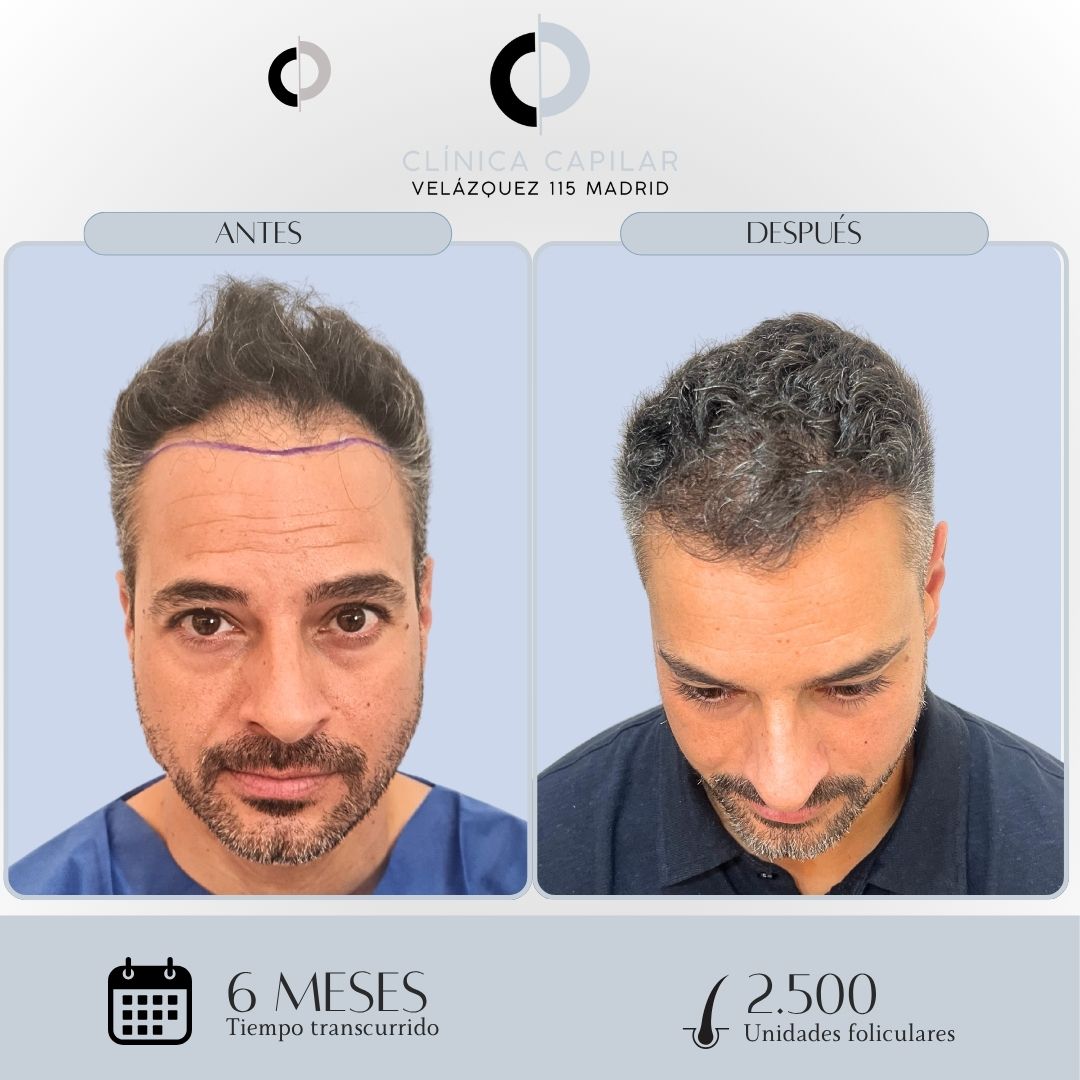 Antes y después injerto capilar de 2.500 unidades de folículos en Clínica Capilar Velázquez