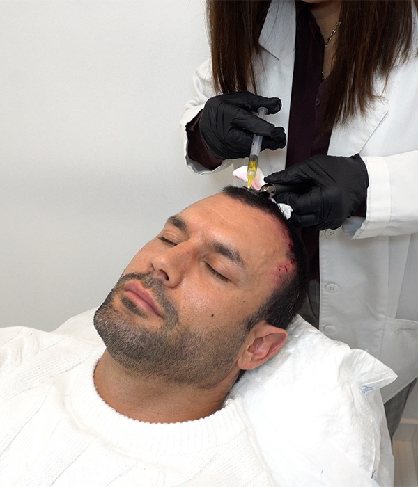 Tratamiento capilar con Jorge Perez Clinica Velazquez